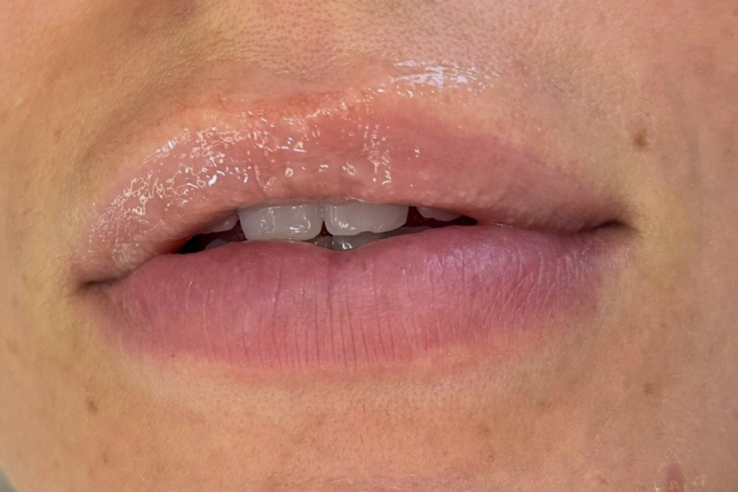 Natural lips, before